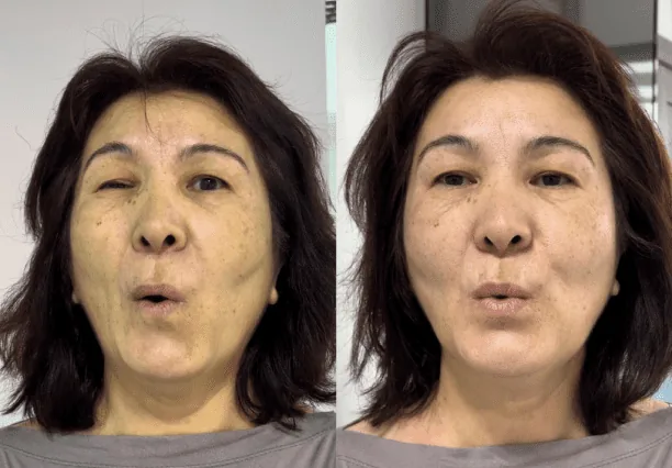 Фото до и после скульптурирующего массажа лица