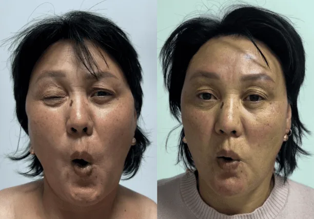 Фото до и после скульптурирующего массажа лица