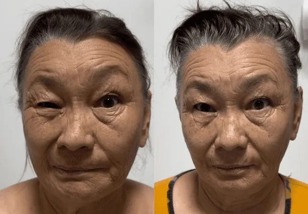 Фото до и после скульптурирующего массажа лица