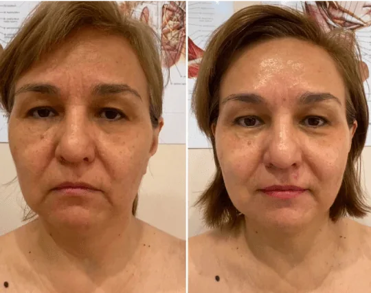 Фото до и после скульптурирующего массажа лица