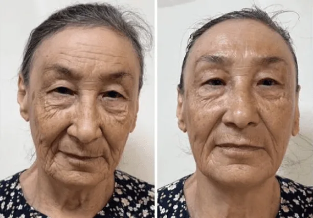 Фото до и после скульптурирующего массажа лица